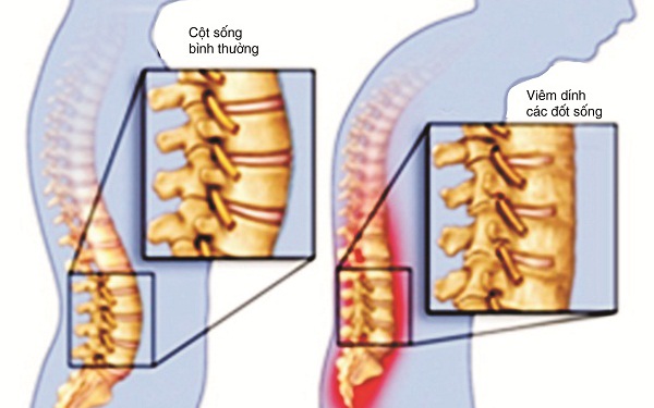 Viêm cột sống dính khớp, điều trị như thế nào?