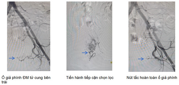 Can thiệp nội mạch bảo tồn tử cung cho sản phụ - Ảnh 2.