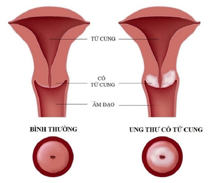 Cổ tử cung quan trọng thế nào trong hệ thống sinh sản của phụ nữ?