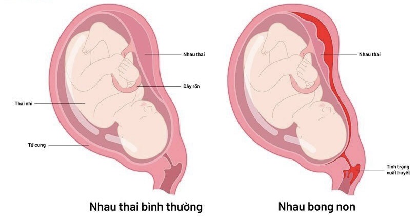 Thai Chết Lưu: Nguyên Nhân, Dấu Hiệu và Biện Pháp Phòng Ngừa