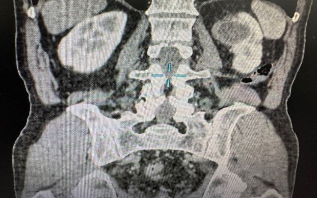 Nang thận có thật sự lành tính? Chuyên gia cảnh báo những dấu hiệu tuyệt đối không được bỏ qua- Ảnh 2. Đau thắt lưng, khám phát hiện mắc nang thận nguy cơ ung thư