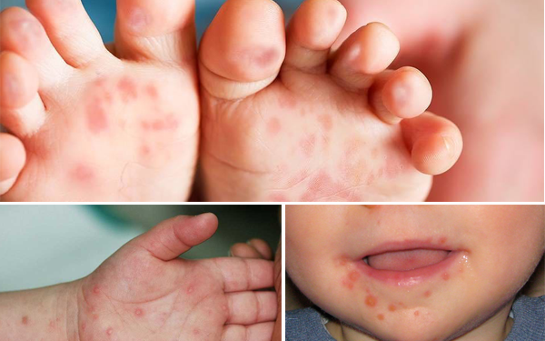 Đã có trẻ tử vong nghi mắc tay chân miệng: 6 khuyến cáo của Bộ Y tế phòng chống bệnh cần biết