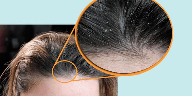 Dầu xả gàu, dưỡng tóc công thức nấm men Hensio 500ml - CÔNG TY TNHH THƯƠNG  MẠI SẢN XUẤT HABICO