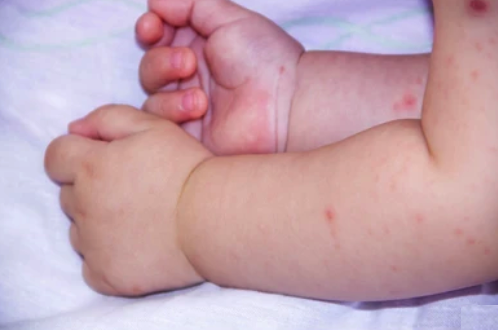 5 dấu hiệu cần cho trẻ mắc tay chân miệng nhập viện gấp
