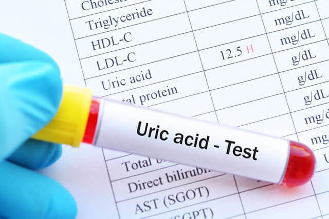 Xét nghiệm acid uric tăng liệu có phải mắc bệnh gout? - Ảnh 1.