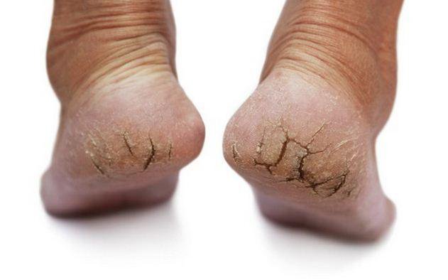 Nứt gót chân là phần da khô ở gót chân bị mất đi độ đàn hồi và tách ra khi trọng lực cơ thể dồn xuống chân.