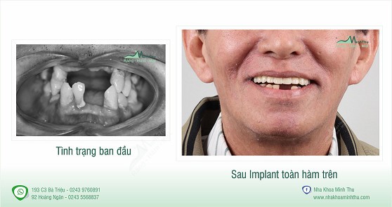 Tại sao cần dùng máng hướng dẫn phẫu thuật Implant trong các ca toàn hàm? - Ảnh 4.