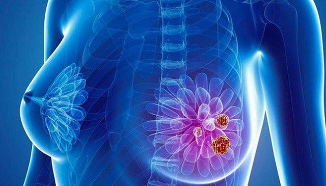 Hầu hết bệnh nhân ung thư vú giai đoạn đầu đều sống sót lâu dài - Ảnh 2.