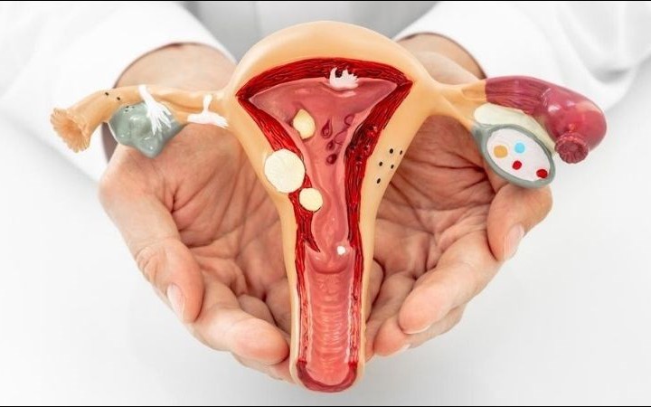 Polyp cổ tử cung có gây ra ung thư cổ tử cung?