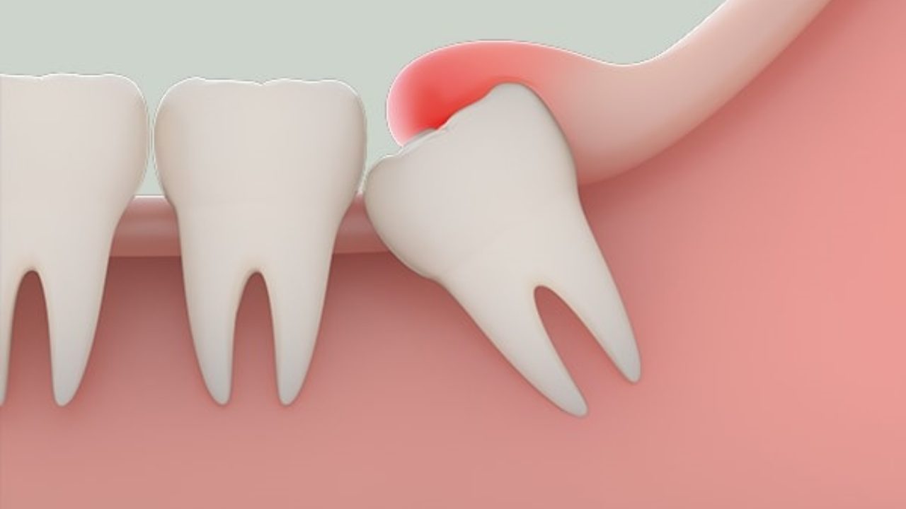 Nhổ răng số 8 có thể gặp biến chứng gì và lưu ý cần ghi nhớ - Ảnh 2.