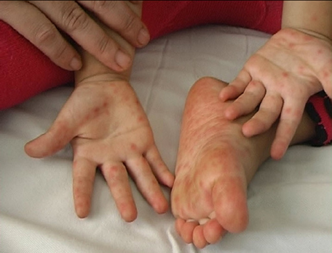 Số ca mắc bệnh tay chân miệng tiếp tục gia tăng ở TP.HCM - Ảnh 1.
