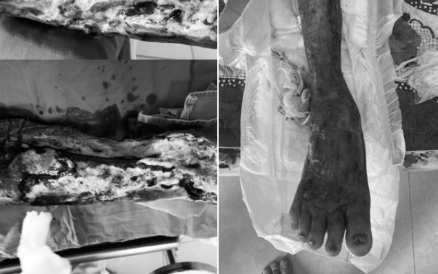 Loại vi khuẩn cực độc "ăn mòn" cẳng chân người đàn ông
