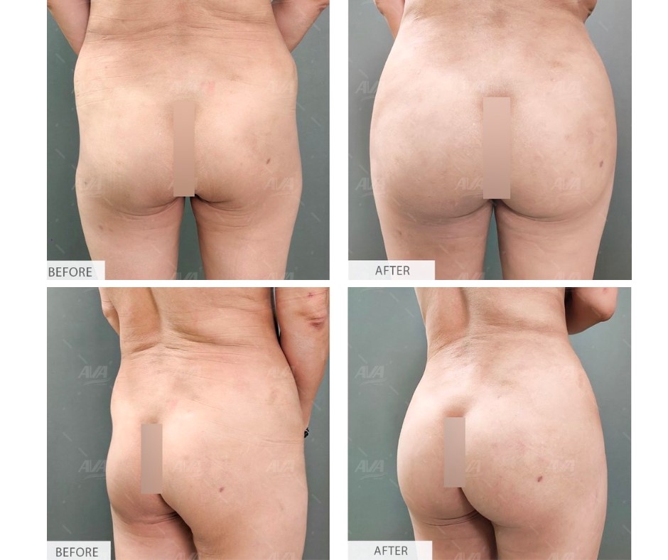 Tại sao bơm mỡ mông là thủ thuật thẩm mỹ nguy hiểm?