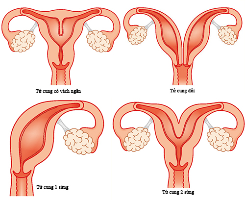Siêu âm tử cung giúp phụ nữ biết được những bệnh lý gì  medimvn