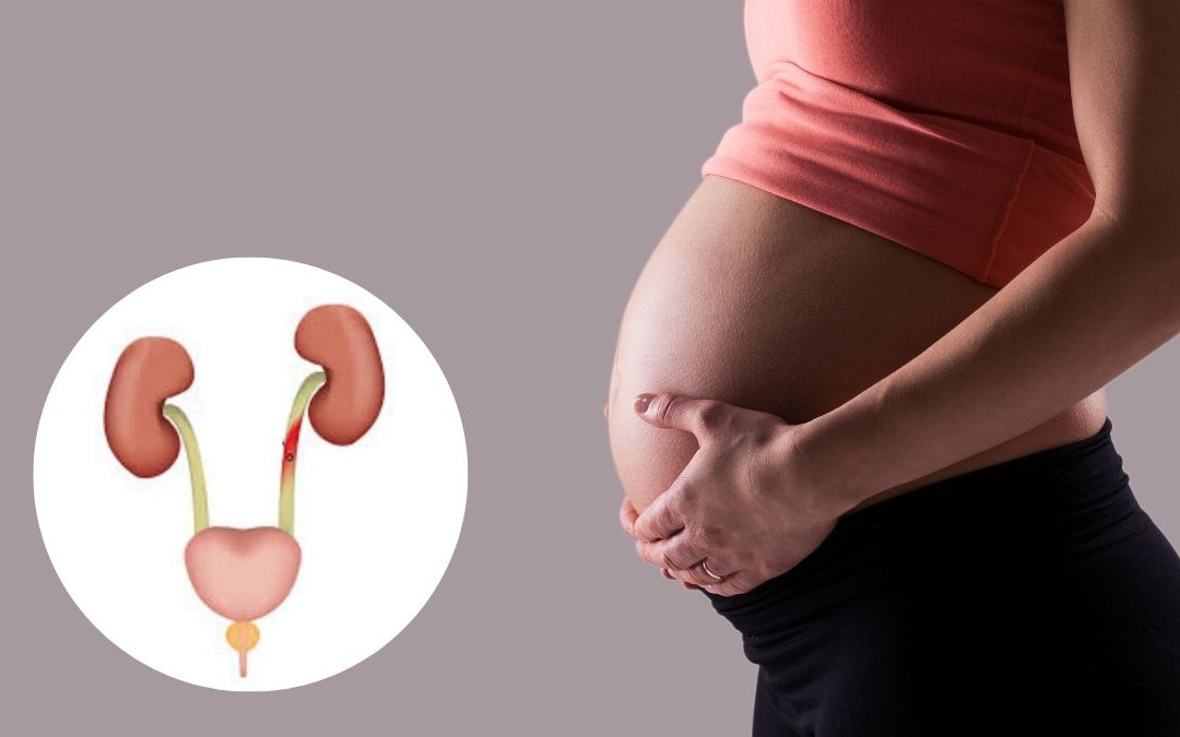 Nhận biết dấu hiệu viêm đường tiết niệu ở mẹ bầu để điều trị sớm, ngừa biến chứng