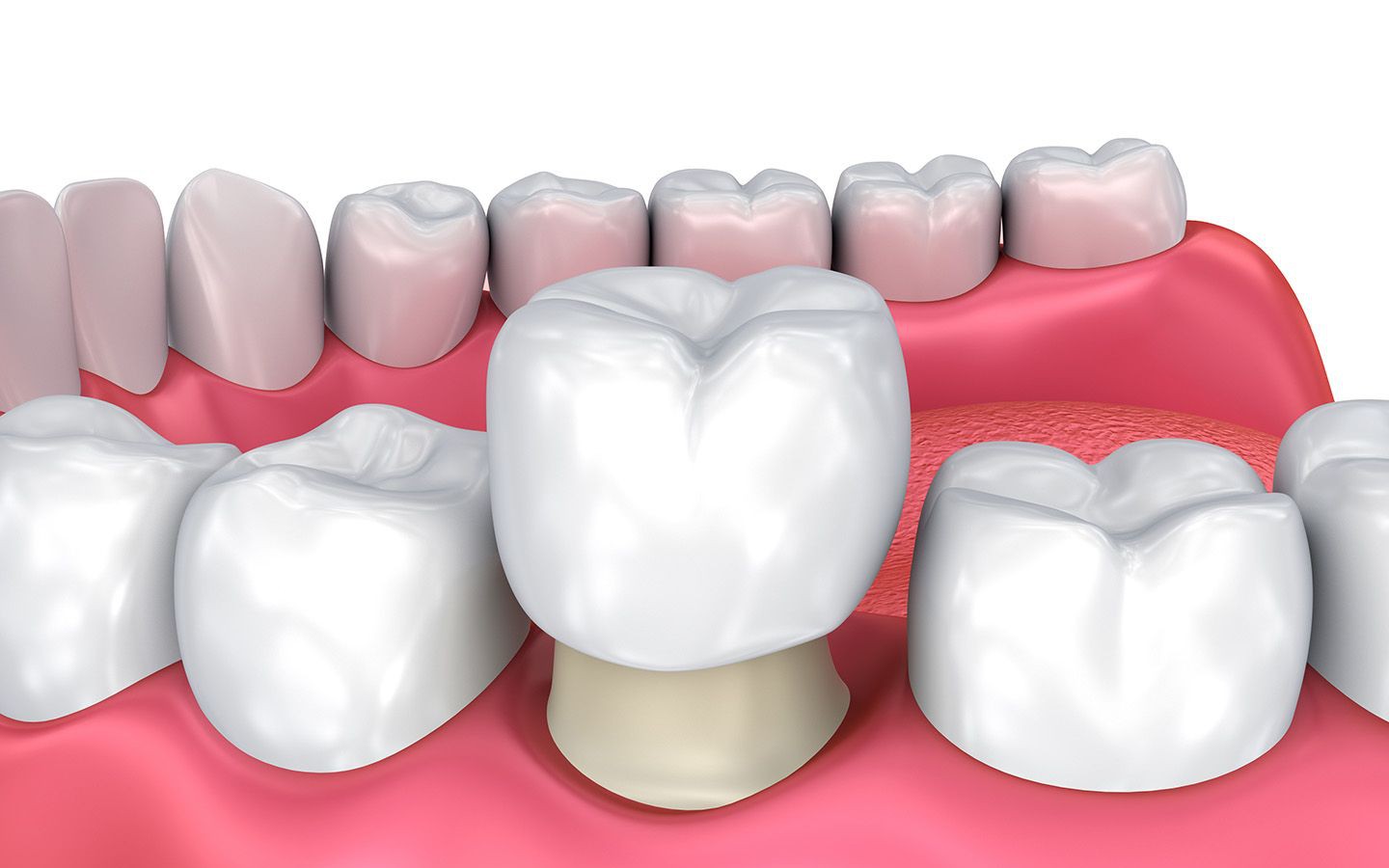 8 mối nguy từ việc bọc răng sứ không đảm bảo chất lượng