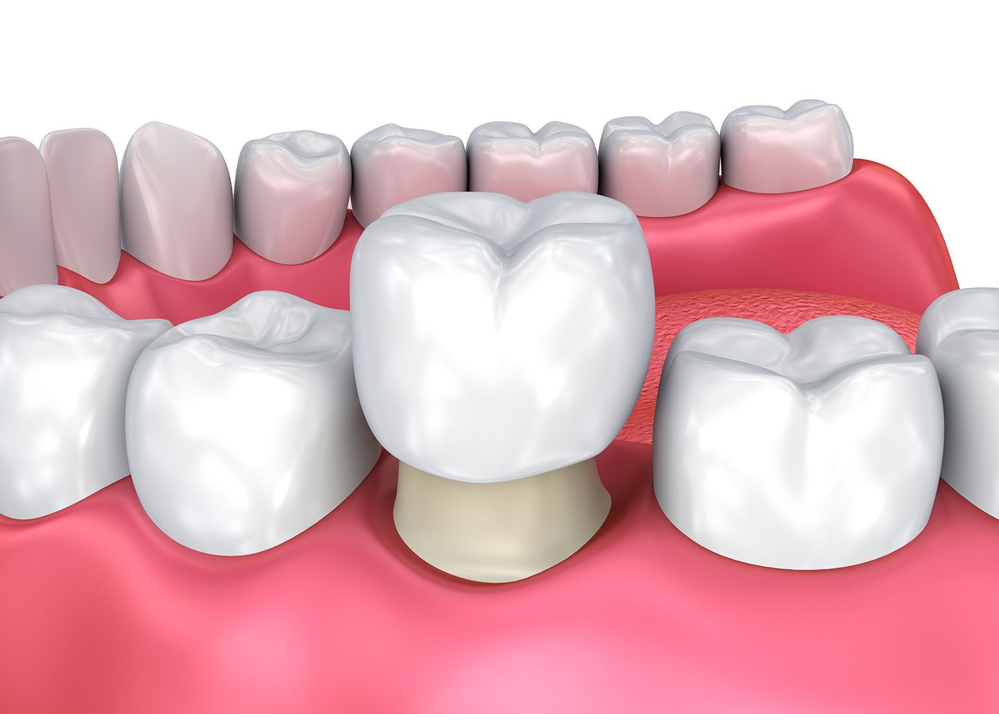 8 mối nguy từ việc bọc răng sứ giá rẻ - Ảnh 2.
