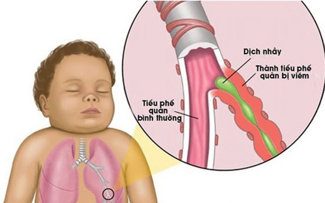 Dấu hiệu nhận biết khi trẻ bị viêm tiểu phế quản