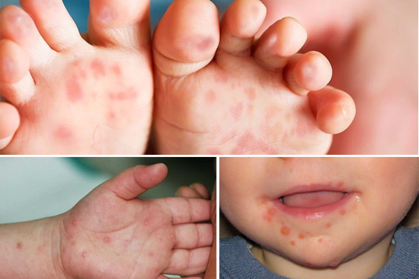 TP.HCM: Đã xác định kiểu gen của Enterovirus 71 gây bệnh tay chân miệng nặng ở trẻ em - Ảnh 1.