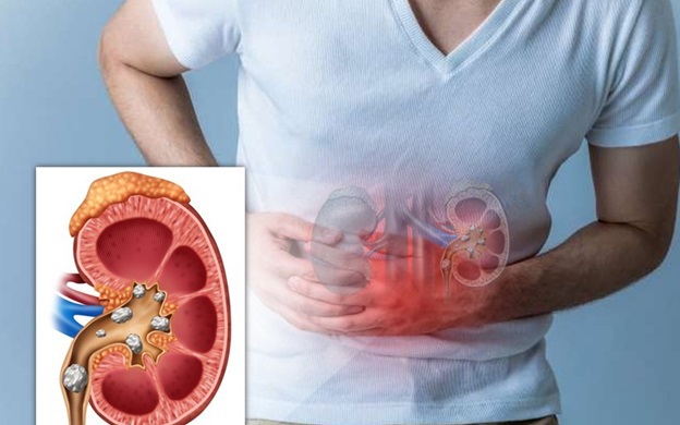 Mắc sỏi thận, nhất định bạn phải biết những điều sau đây