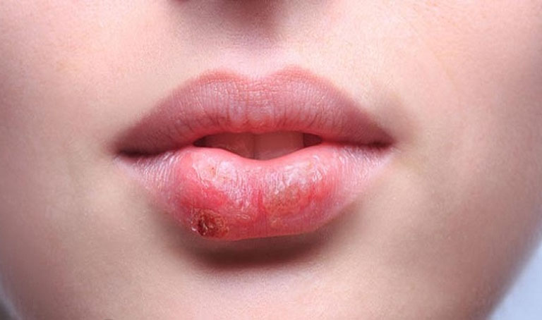 Triệu chứng của bệnh chàm môi