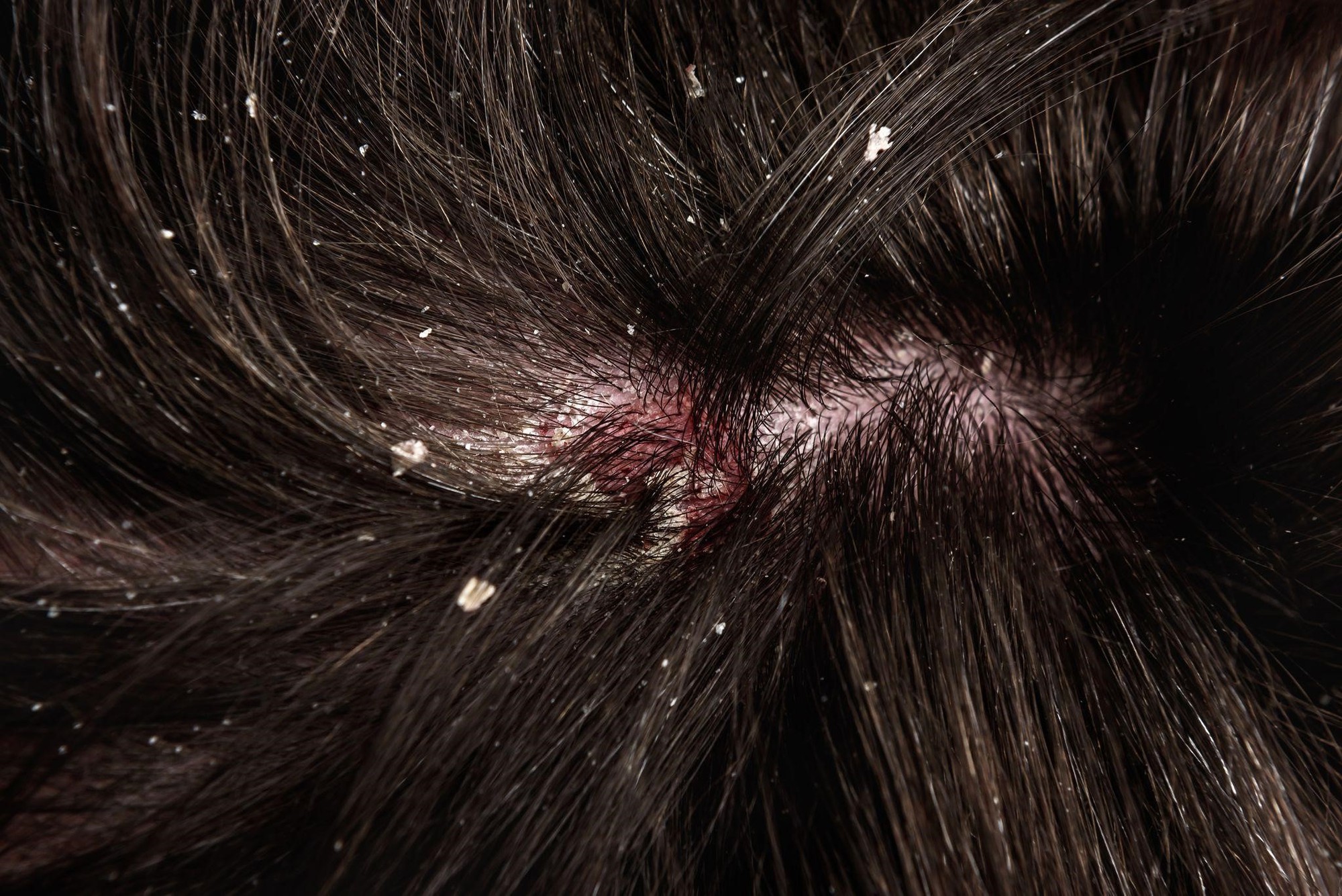 Tẩy da chết da đầu giúp tóc bị xơ rối, da đầu bị gầu, dành cho nam và nữ  Nội địa Trung - Chăm sóc tóc và da đầu | TheFaceHolic.com