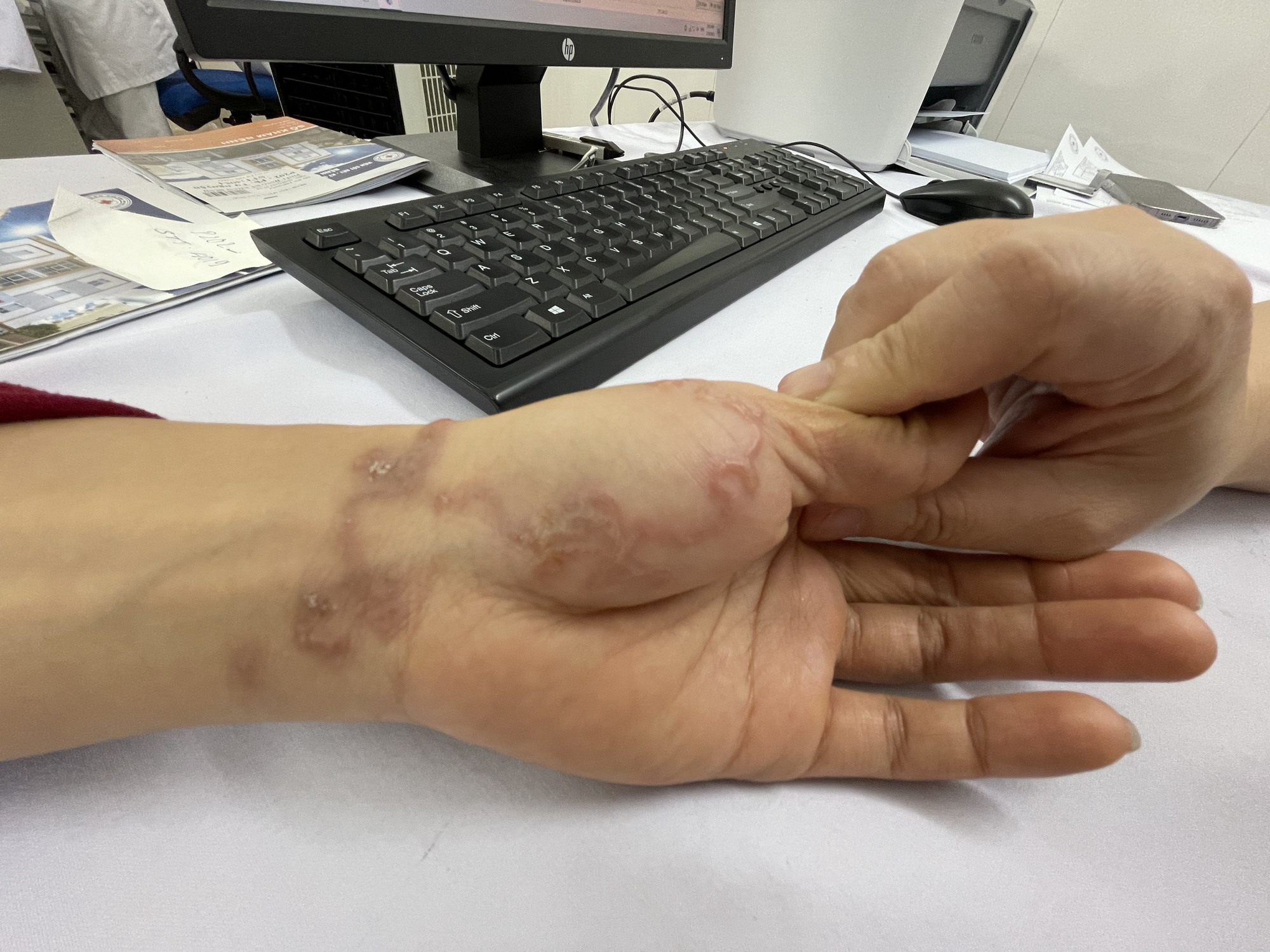 Ấu trùng giun đào hang dưới da, làm tổ loằng ngoằng do thói quen nhiều  người mắc