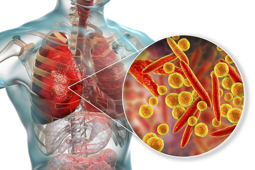 Viêm phổi do vi khuẩn Mycoplasma: Nguyên nhân và dấu hiệu nhận biết - Ảnh 1.