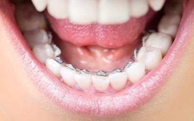 Phương pháp niềng răng nào tối ưu nhất?