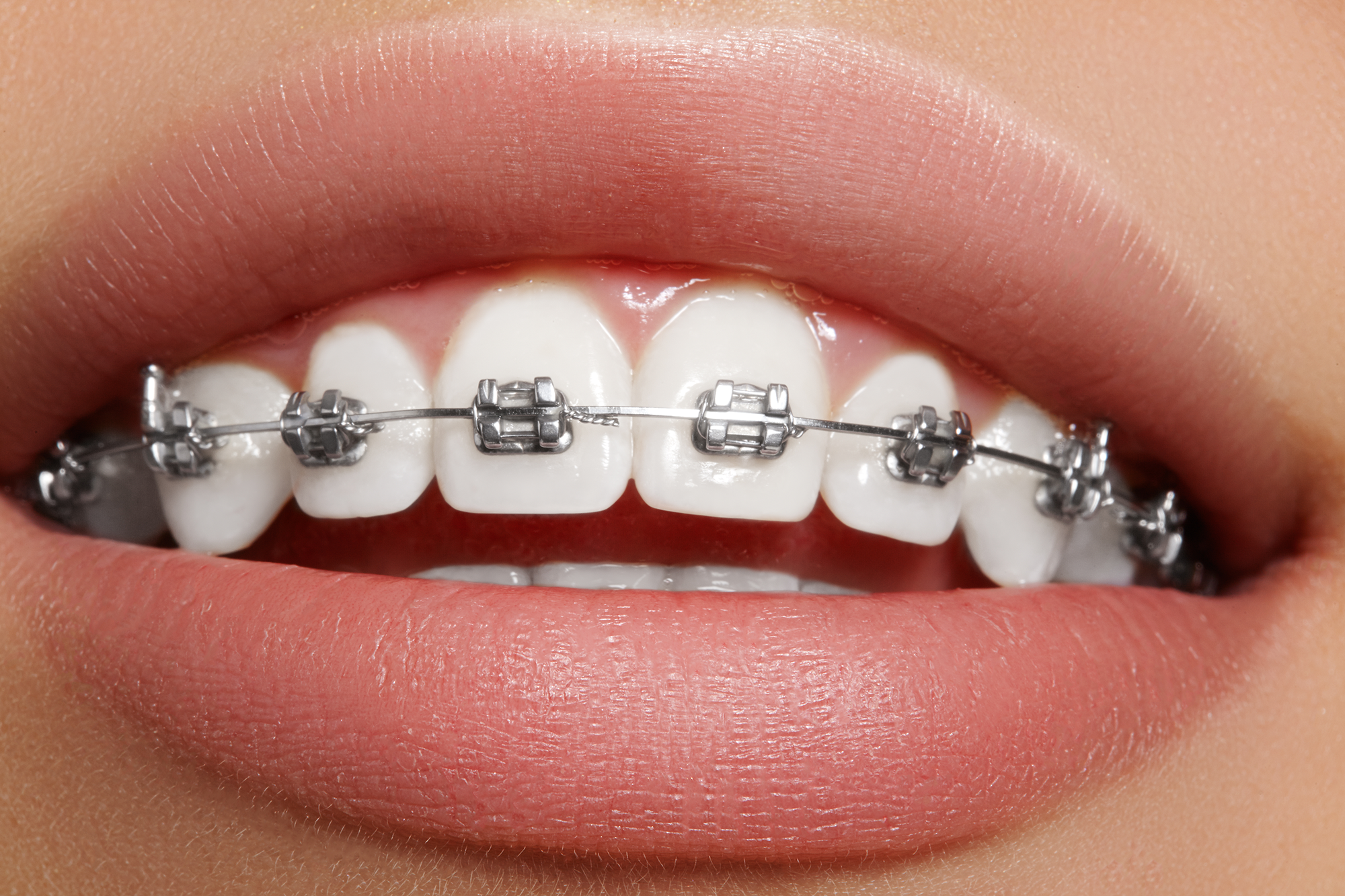 Phương pháp niềng răng nào tối ưu nhất? - Ảnh 4.