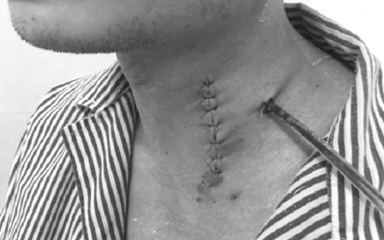 Tai nạn hi hữu: Nam thanh niên bị cọc sắt xuyên qua hậu môn sau cú ngã ngồi- Ảnh 3.