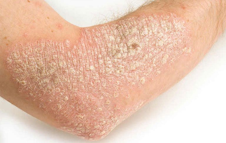 hình ảnh viêm da cơ địa