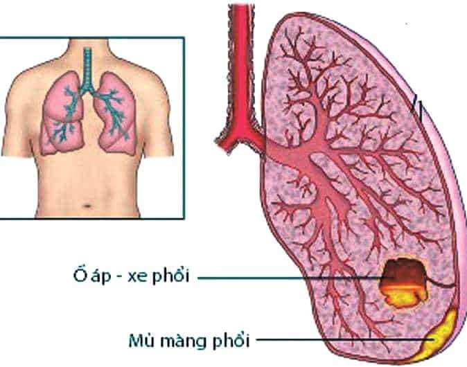 3 biểu hiện áp xe phổi ở trẻ và những biến chứng  - Ảnh 2.