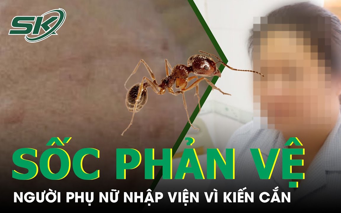 Nhập viện cấp cứu sau khi bị kiến đốt do sốc phản vệ