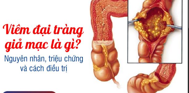 Đau bụng, tiêu chảy khi uống kháng sinh thận trọng với viêm đại tràng giả mạc - Ảnh 1.
