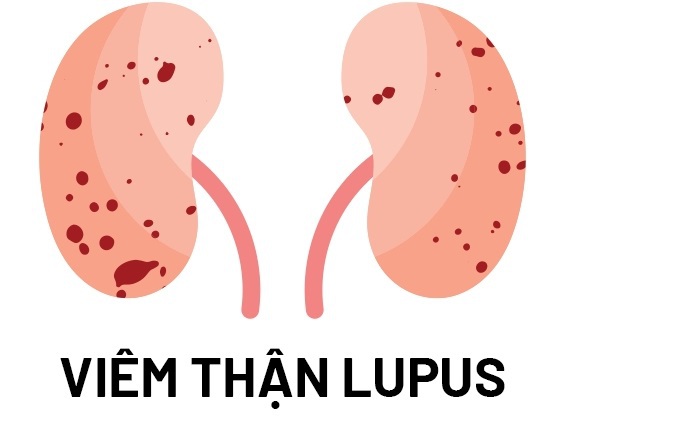 Bước ngoặt mới cho bệnh nhân viêm thận lupus