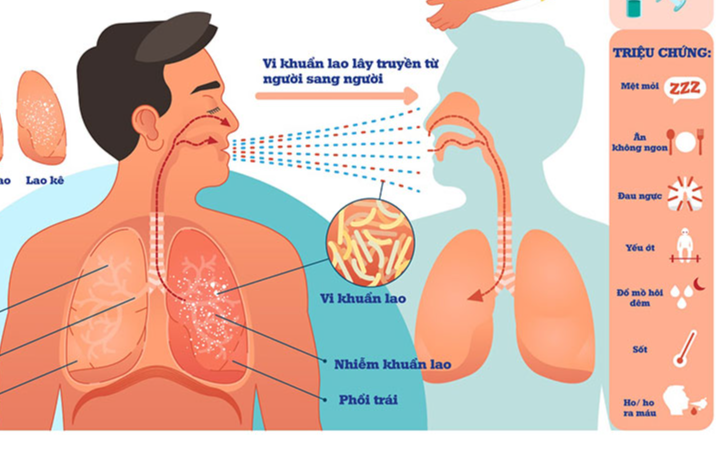 Yếu tố nguy cơ và cách phòng ngừa lao phổi