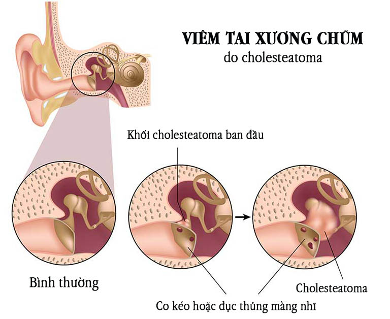 Viêm tai xương chũm biểu hiện như nào và biến chứng