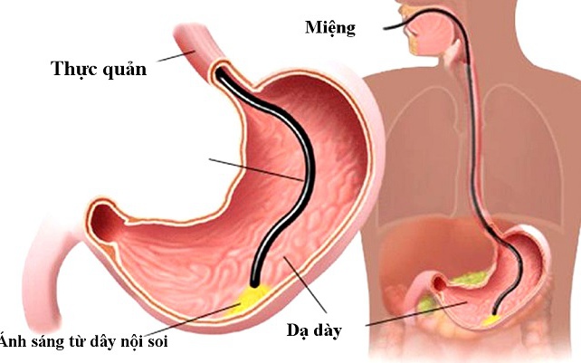 Nội soi tiêu hóa cho trẻ cần chú ý những gì?