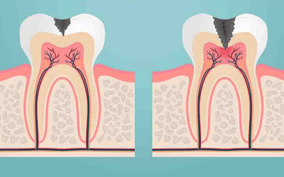 Những biến chứng nguy hiểm của viêm tủy răng