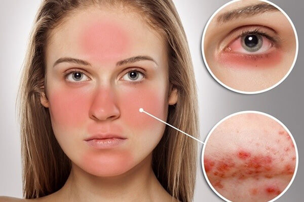 Biểu Hiện Của Bệnh Lupus Ban Đỏ