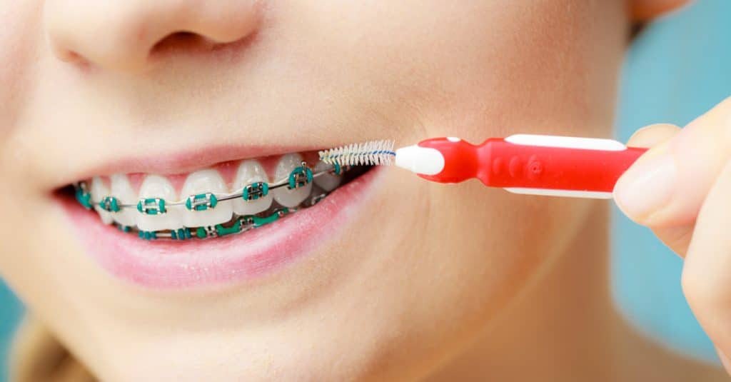 Cách chăm sóc răng miệng cho trẻ trong thời gian niềng răng