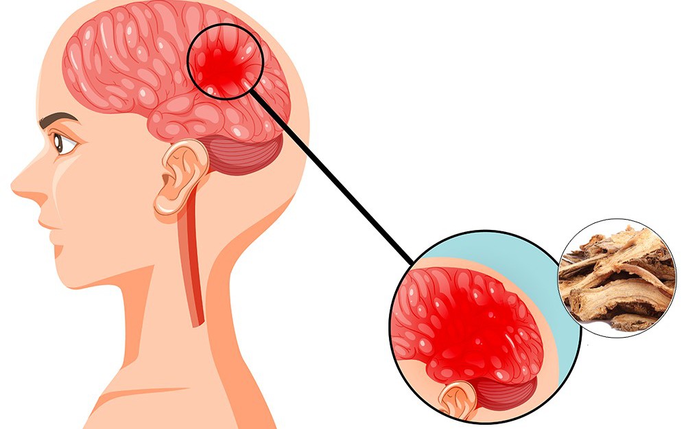 5 vị thuốc trị thiếu máu não, cách sử dụng và lưu ý khi dùng