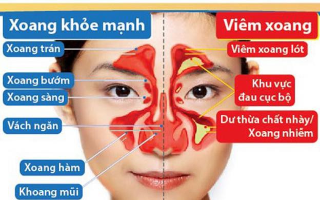 Thực dưỡng cho người bệnh viêm xoang