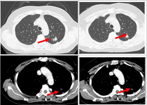Nữ bệnh nhân mắc ung thư phổi di căn có đột biến gen hiếm gặp - Ảnh 2.