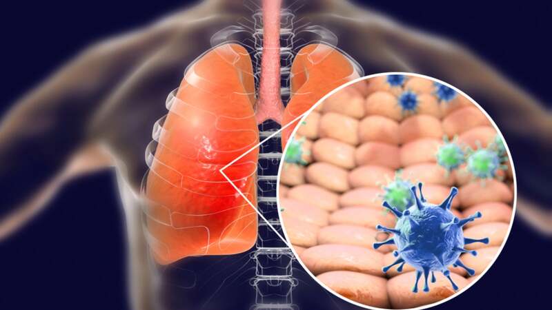 Suy hô hấp nguy kịch do bệnh phổi tắc nghẽn mạn tính, dấu hiệu để phát hiện sớm - Ảnh 2.