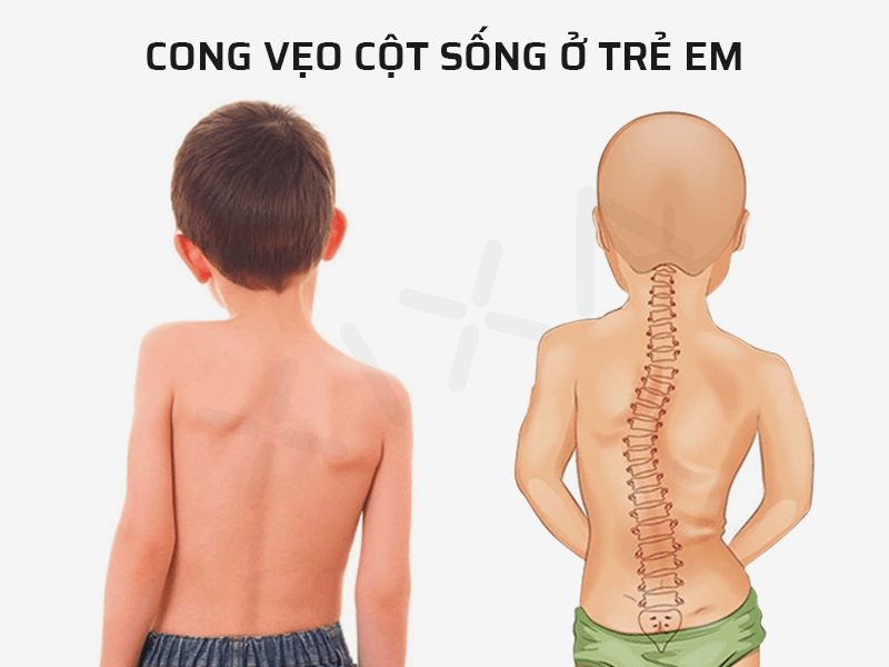 Trẻ bị cong vẹo cột sống: Nguyên nhân, triệu chứng và cách điều trị hiệu quả