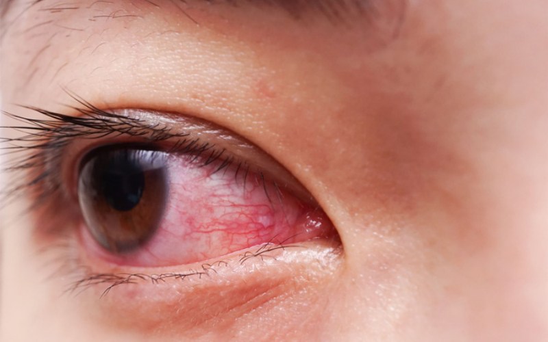 Nhìn vào mắt người đau mắt đỏ có bị lây không?