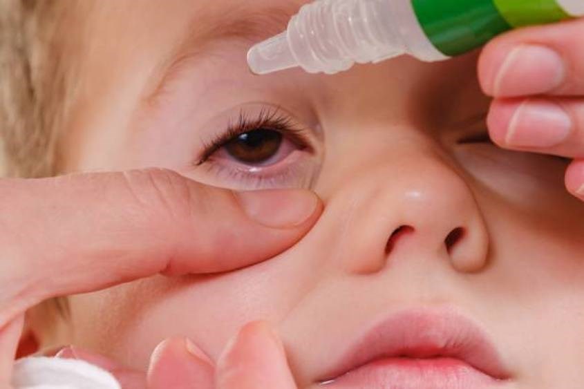 Sử dụng thuốc nhỏ mắt ở trẻ em đúng cách tại nhà - Ảnh 2.