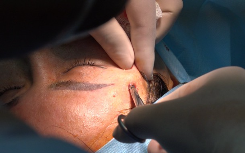 Tiêm filler ở cơ sở "chui", một phụ nữ suýt bị mù mắt